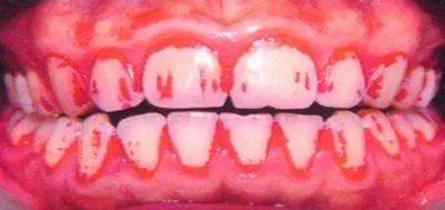 牙菌斑是什么？
