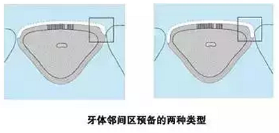 贴面备牙知多少？