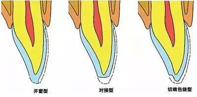 贴面备牙知多少？