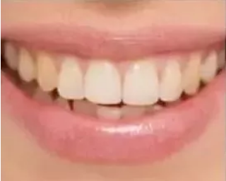 瓷贴面修复体最终颜色的影响因素 瓷贴面修复体最终颜色的影响因素