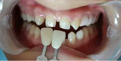 瓷贴面修复体最终颜色的影响因素 瓷贴面修复体最终颜色的影响因素