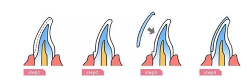 瓷贴面修复体最终颜色的影响因素 瓷贴面修复体最终颜色的影响因素
