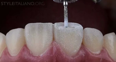 21 22牙齿使用完全相同的技术进行充填,每次充填一颗. 图24.