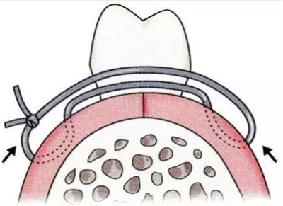 【牙周外科的基本技术技能】术后管理
