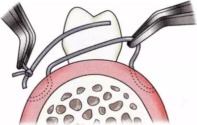 【牙周外科的基本技术技能】术后管理