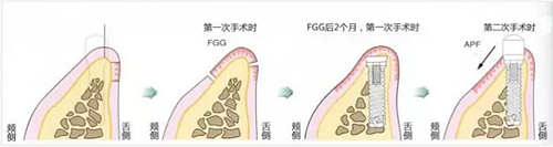 种植体周围角化龈的获得时期与方法