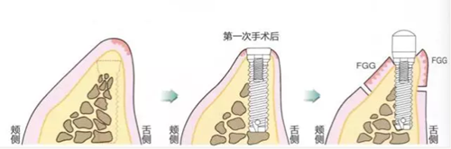 种植体周围角化龈的获得时期与方法