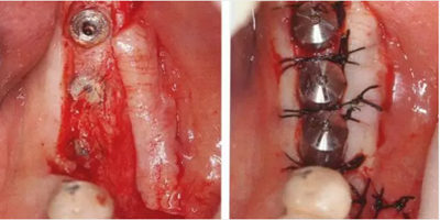 种植体周围角化龈的获得时期与方法