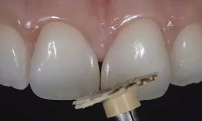 [牙体牙髓] 【分享】牙间隙收缩术一例