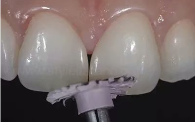 [牙体牙髓] 【分享】牙间隙收缩术一例