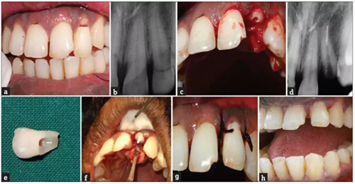  [牙体牙髓] 【病例报告】纤维桩及牙折片重粘接修复折断牙  