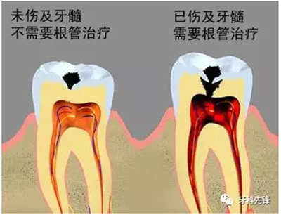 补牙不做冠，疗效少一半！根管治疗后牙齿已经不疼了，为什么还要戴牙冠呢？