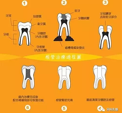 补牙不做冠，疗效少一半！根管治疗后牙齿已经不疼了，为什么还要戴牙冠呢？