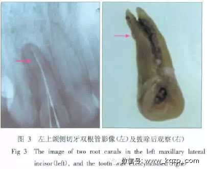 X线牙片在牙齿疑难病例诊断中的参考价值