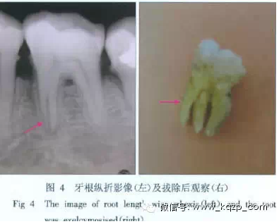 X线牙片在牙齿疑难病例诊断中的参考价值