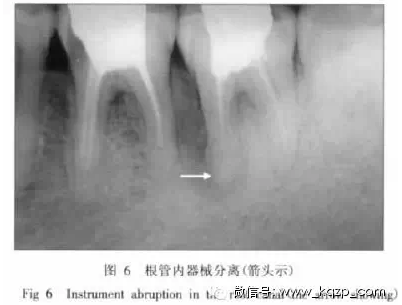 X线牙片在牙齿疑难病例诊断中的参考价值