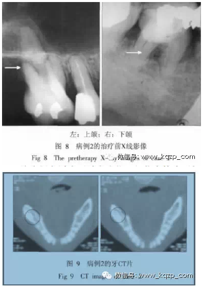 X线牙片在牙齿疑难病例诊断中的参考价值