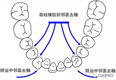 邻面去釉技术详解