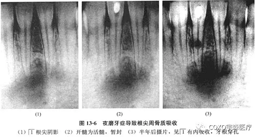 根尖周病与夜磨牙症