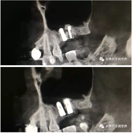 失败上颌窦种植患者的补救