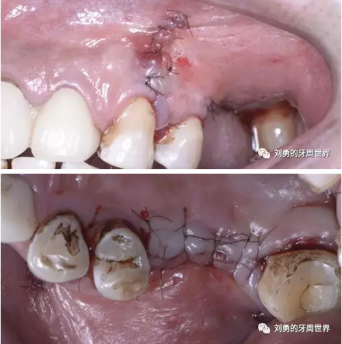 一例失败上颌窦种植患者的补救