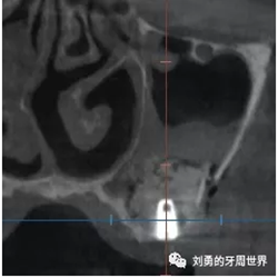 一例失败上颌窦种植患者的补救