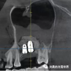 一例失败上颌窦种植患者的补救