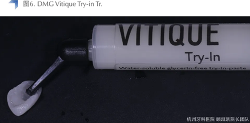Vitique瓷贴面粘接系统的临床应用