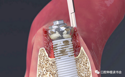 种植体周围炎的软硬组织重建治疗（上）