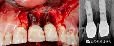 种植体周围炎的软硬组织重建治疗（上）
