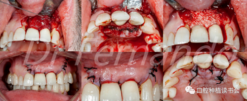 种植体周围炎的软硬组织重建治疗（上）