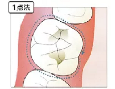 牙周袋深度测定法