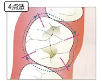 牙周袋深度测定法