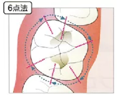 牙周袋深度测定法