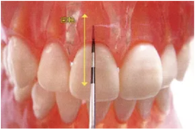 牙周袋深度测定法