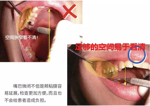 牙周袋深度测定法