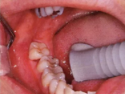 牙周袋深度测定法