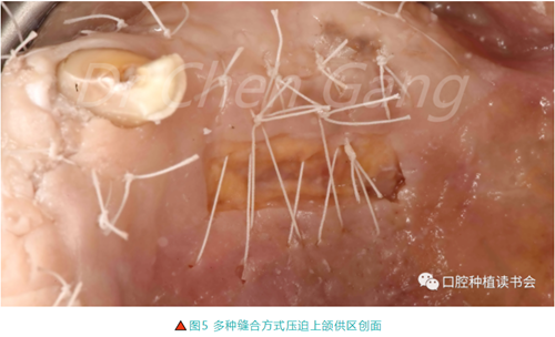 高清图解｜游离牙龈（FGG）的获取与移植技术