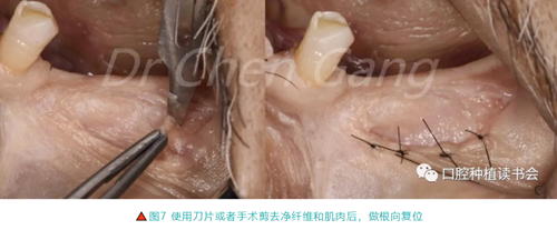 高清图解｜游离牙龈（FGG）的获取与移植技术