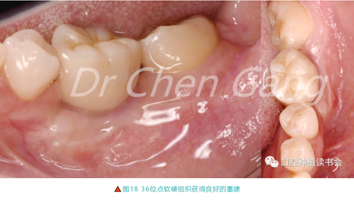 高清图解｜游离牙龈（FGG）的获取与移植技术