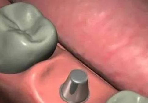 最详细的种植牙流程