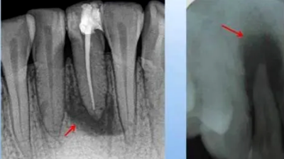 各类根尖周病的X片表现