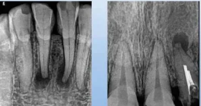各类根尖周病的X片表现