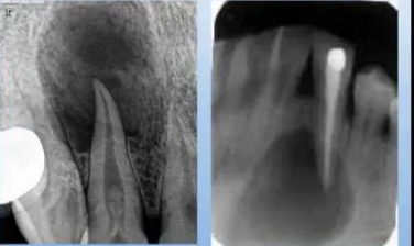 各类根尖周病的X片表现