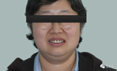 【病例分享】应用全程数字化对牙周炎患者实现全口即刻种植即刻修复
