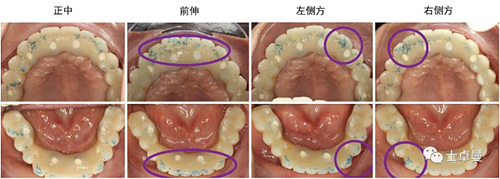 【病例分享】应用全程数字化对牙周炎患者实现全口即刻种植即刻修复