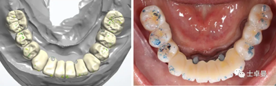 【病例分享】应用全程数字化对牙周炎患者实现全口即刻种植即刻修复