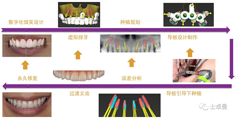 【病例分享】应用全程数字化对牙周炎患者实现全口即刻种植即刻修复