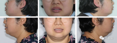 【病例分享】应用全程数字化对牙周炎患者实现全口即刻种植即刻修复