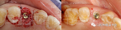 后牙区即刻种植临床指南